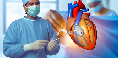 Promising Study Reveals Impella 5.5 Safety in High-Risk Cardiac Surgery Patients
